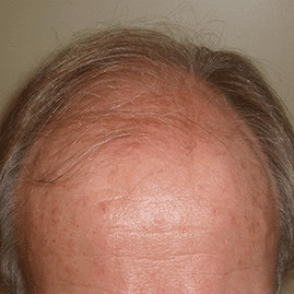 hair transplant before and after
