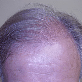 hair transplant before and after