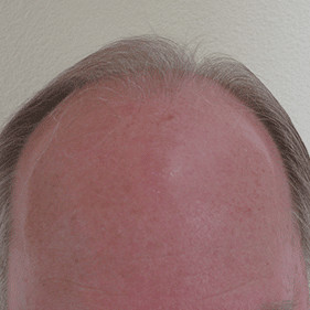 hair transplant before and after