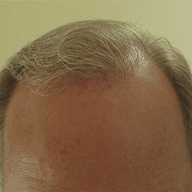 hair transplant before and after