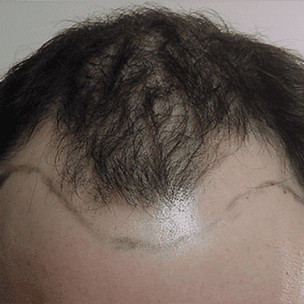 hair transplant before and after