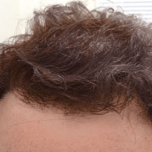 hair transplant before and after