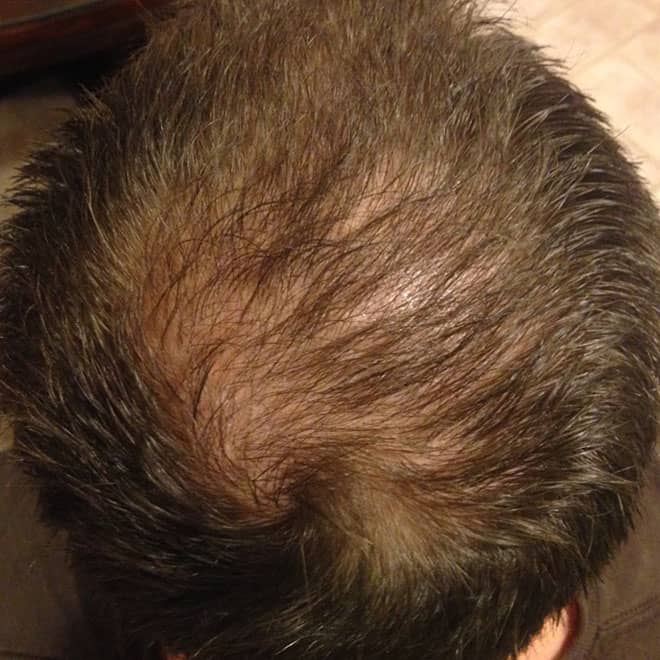 hair transplant before and after
