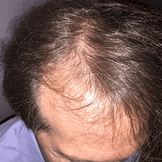 hair transplant before and after